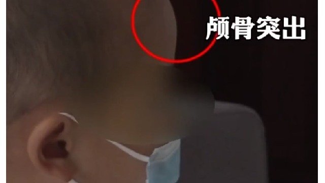 医商勾结推销假奶粉 湖南再现 “ 大头娃娃 ” (图)