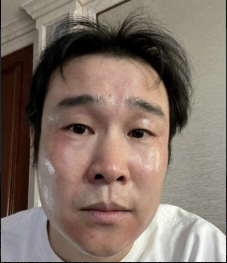 中国演员“小沈阳”早前亦自爆感染新冠,最大的不良反应是面部过敏。(图片来源:微博截图)